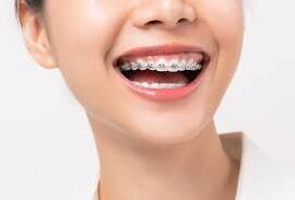 Pilihan Warna Behel yang Cocok dan Tips Memilihnya untuk Senyuman Menawan